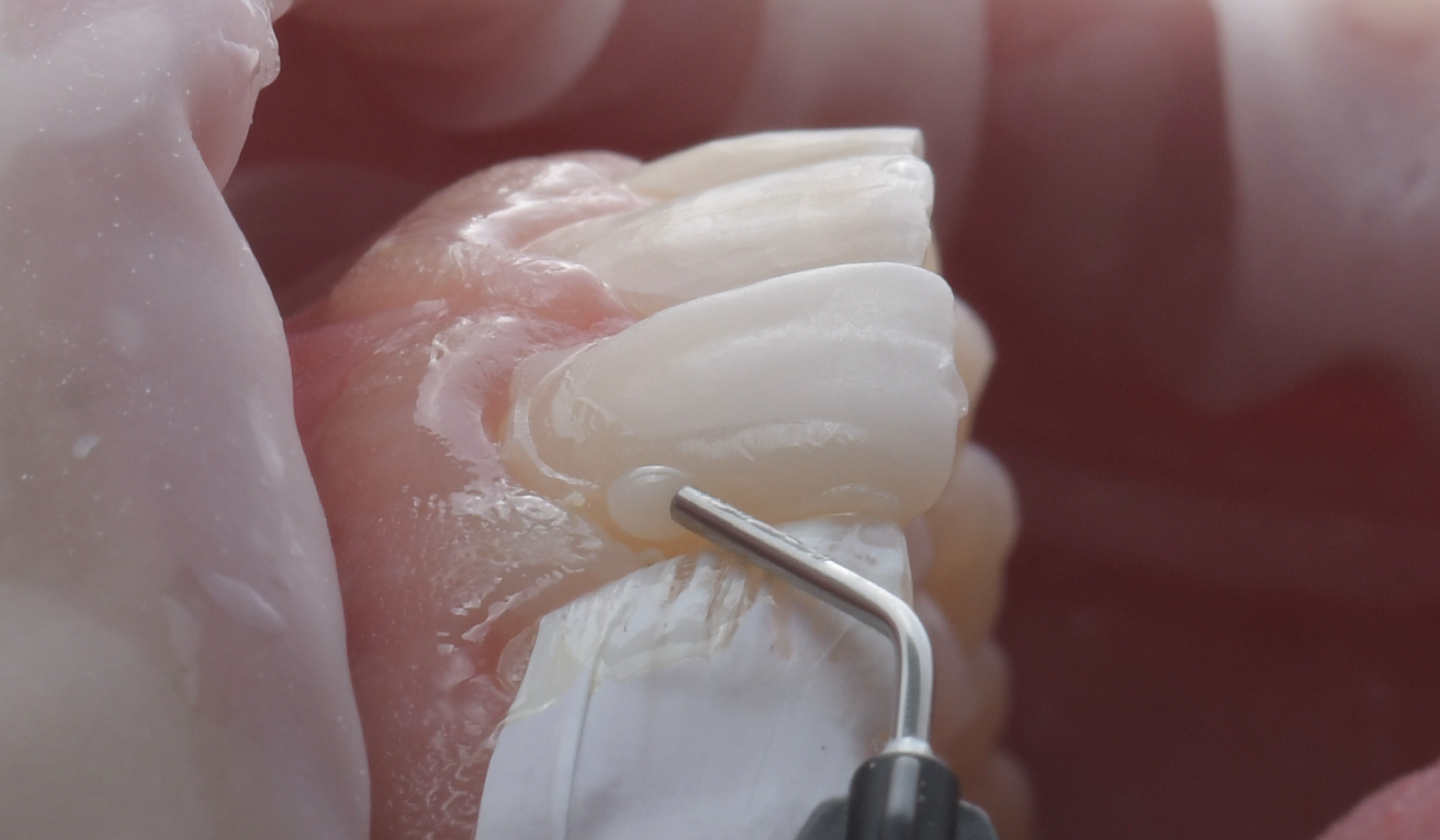 Figure 9: Application of composite material to restore the defect.